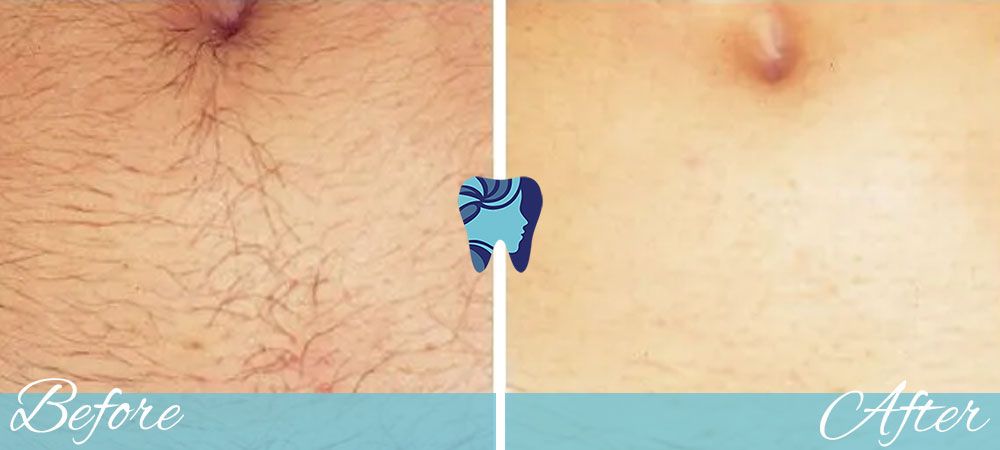 Laser Hair Removal before and after - lower belly hair