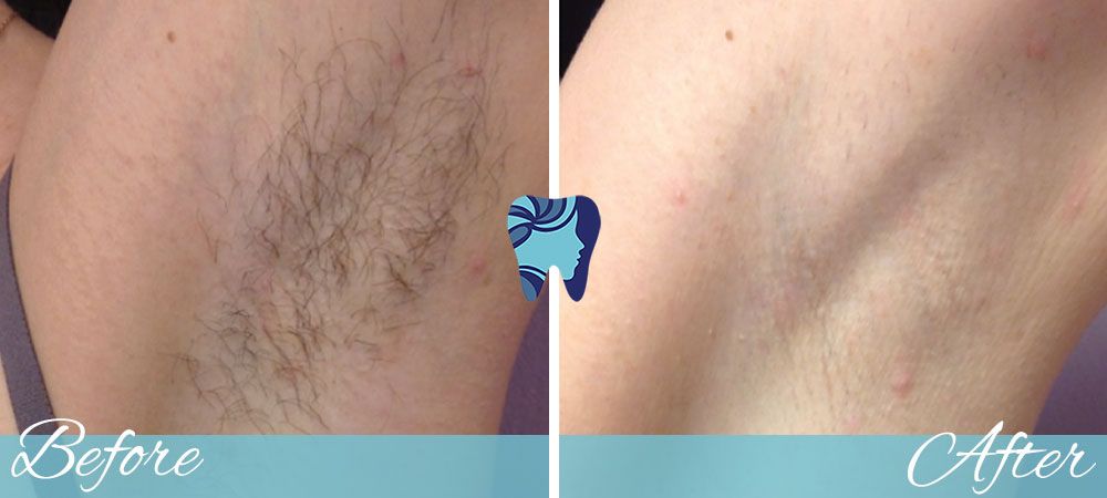 Laser Hair Removal before and after - female underarm